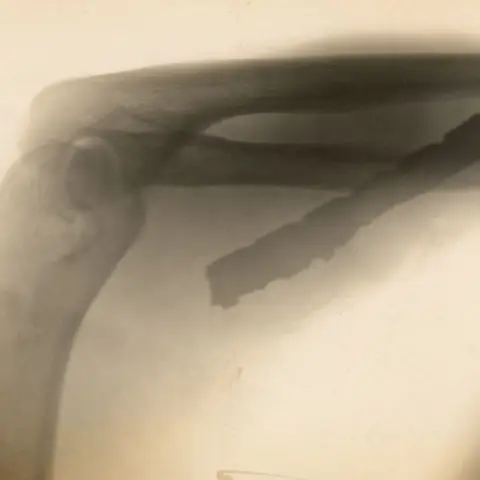 X-ray image showing severe shrapnel wounds to his left elbow.