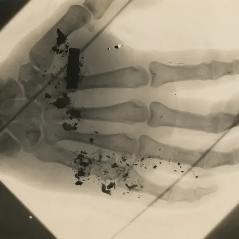 X-ray image showing shrapnel in a hand