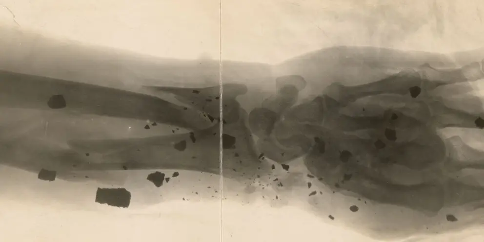 An X-ray image showing shrapnel and fractures in a soldier’s forearm. 