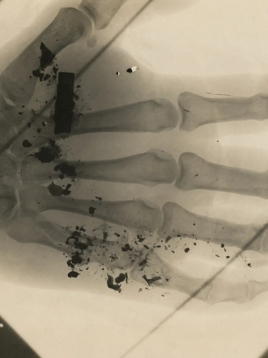 X-ray image showing shrapnel in a hand